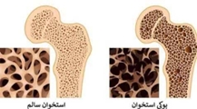 آغاز هفته ملی سلامت استخوان 